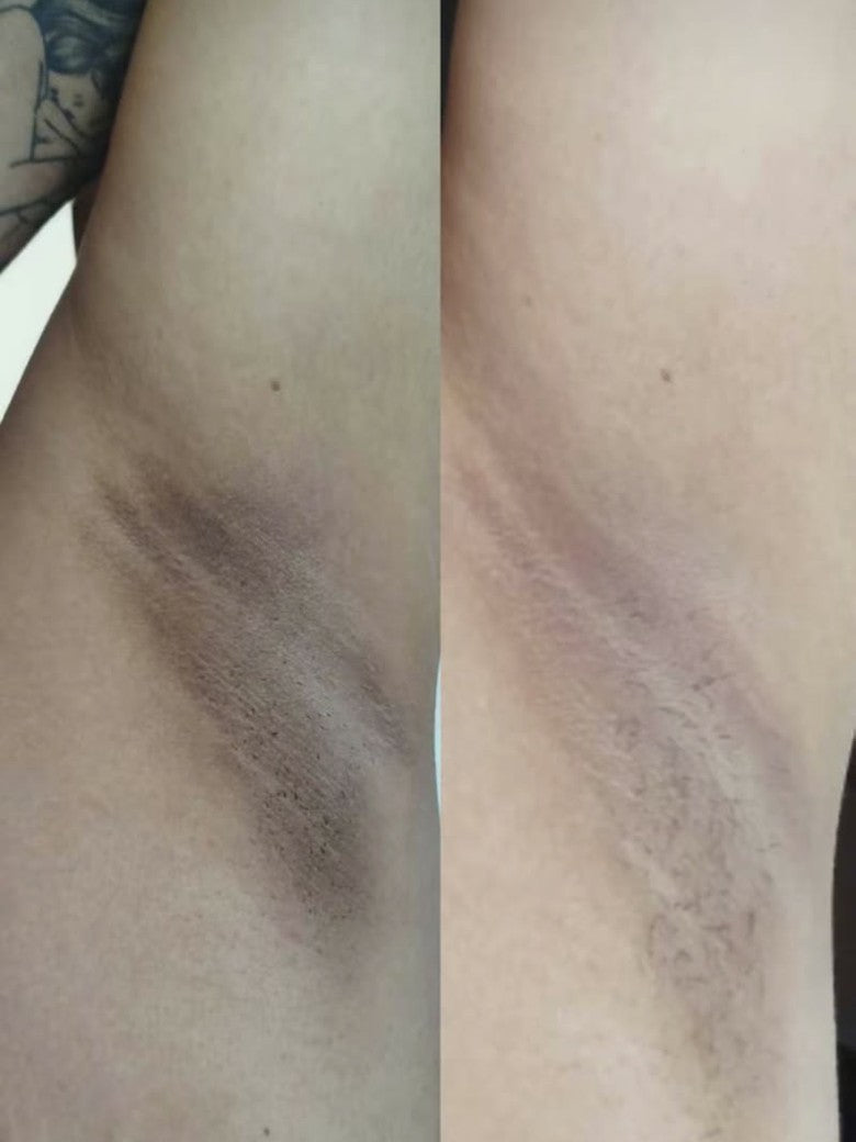 Foto da avaliação: axila antes e depois de 12 dias de uso