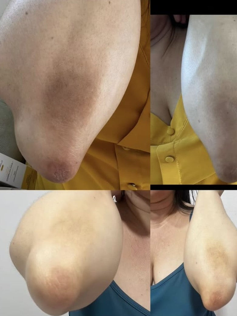 Foto da avaliação: cotovelo antes e depois de 2 meses de uso