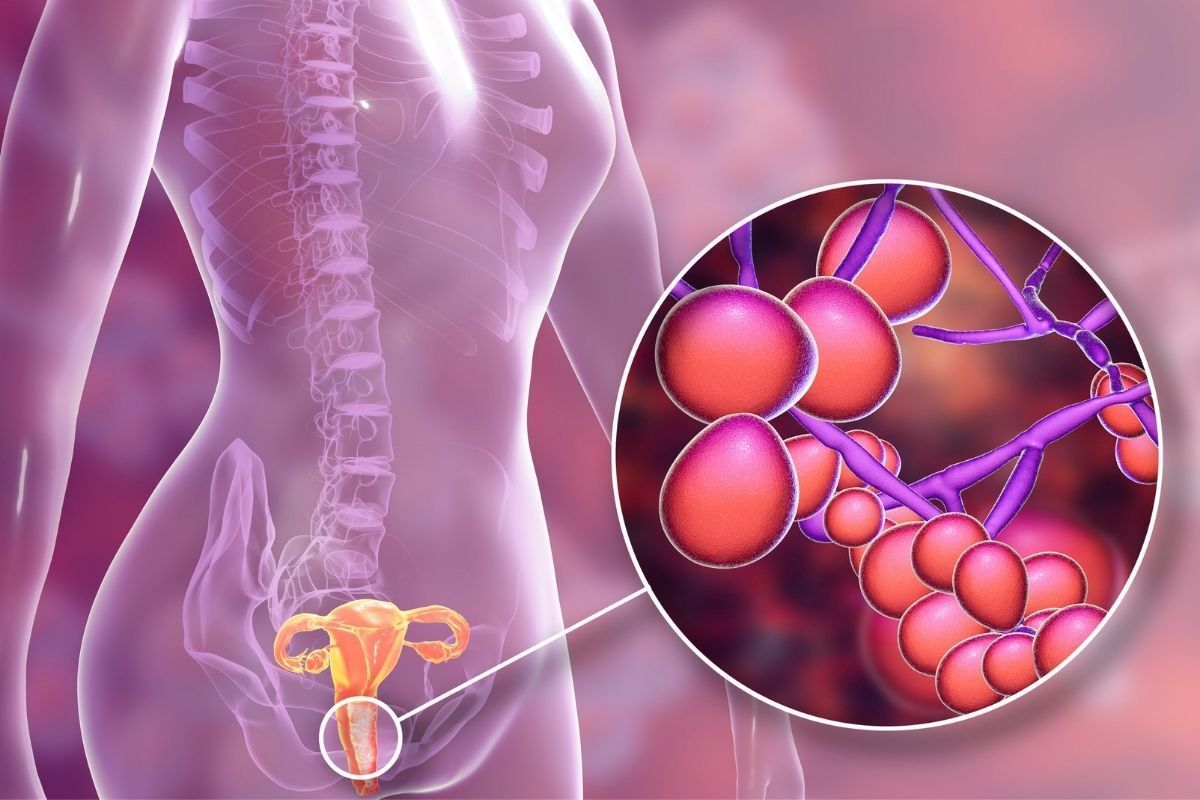 Ilustração médica do fungo Candida no organismo feminino